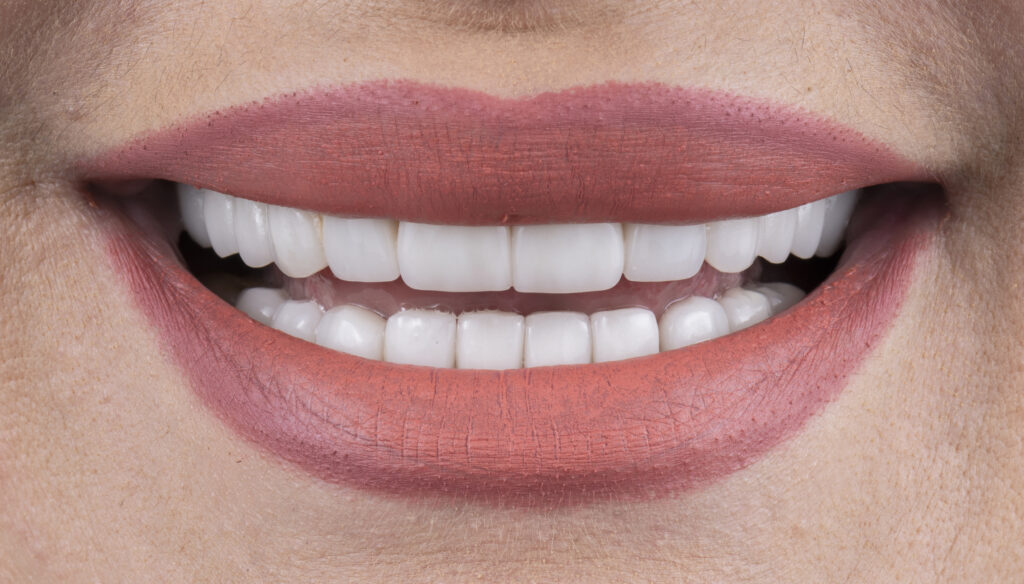 Carillas dentales