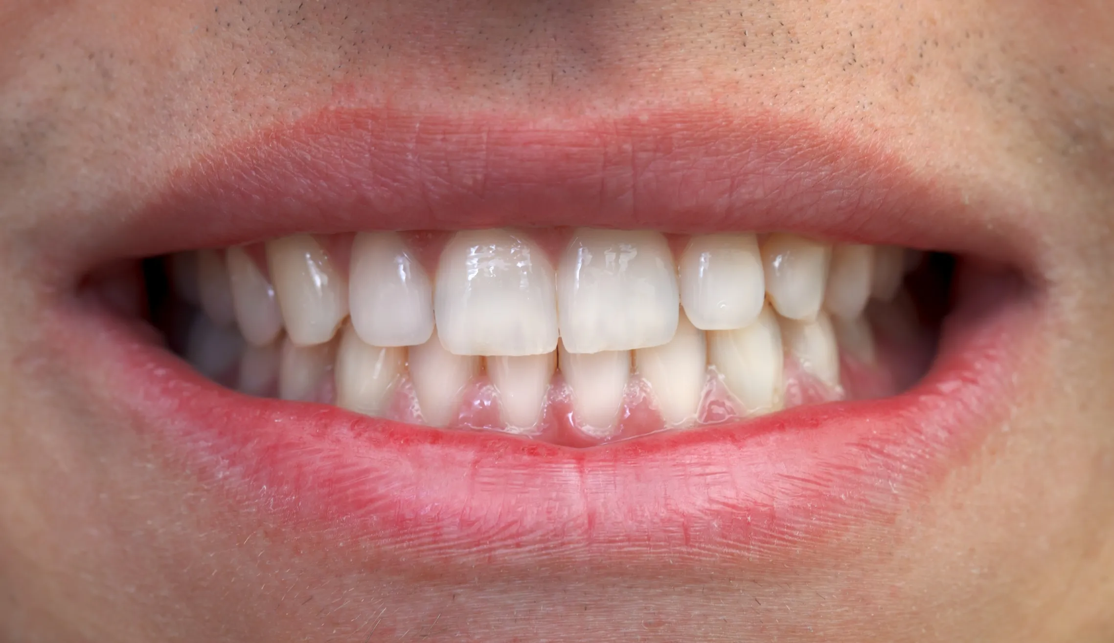 Post blanqueamiento dental