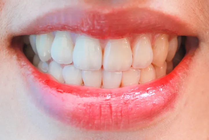 Post blanqueamiento dental v2