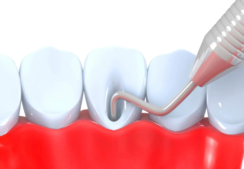 Post endodoncia