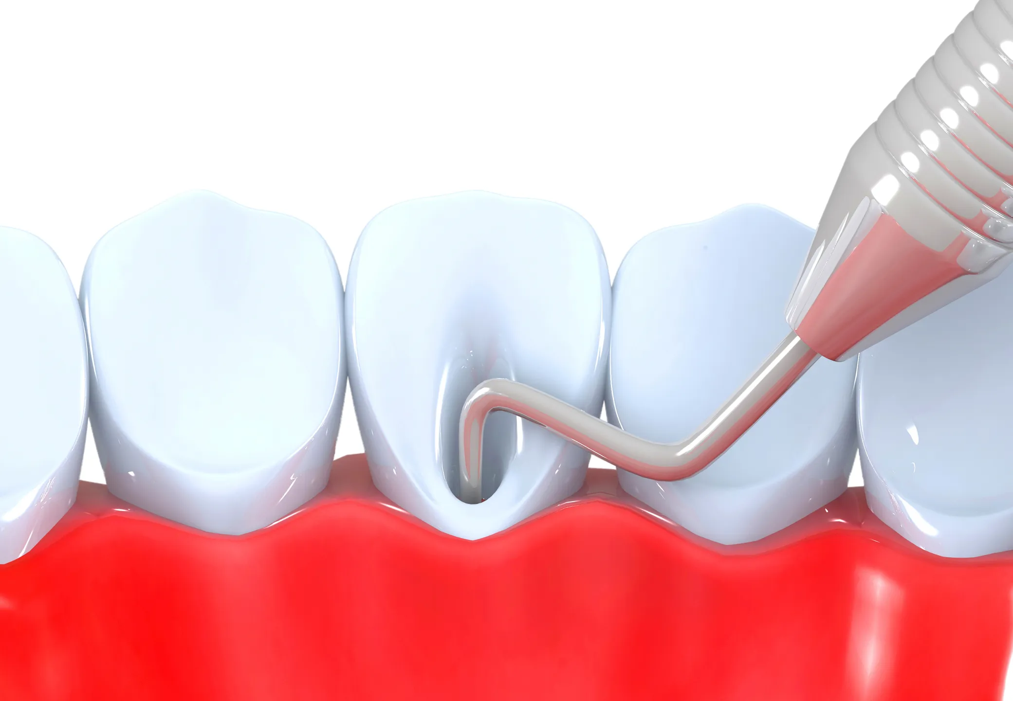 Post endodoncia