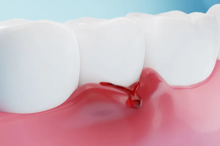 Post gingivitis