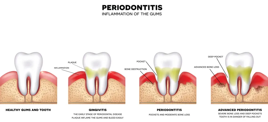 Post gingivitis